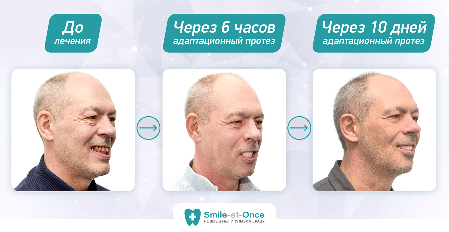До и после имплантации all-on-4