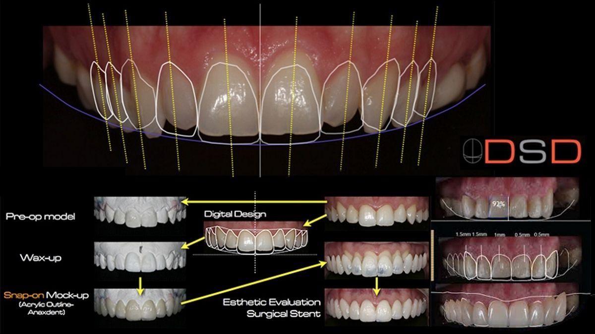 Зубы из цифрового цирка. Digital smile Design в стоматологии. Программа DSD (Digital smile Design). Компьютерное моделирование виниров. Моделирование зубов улыбки.