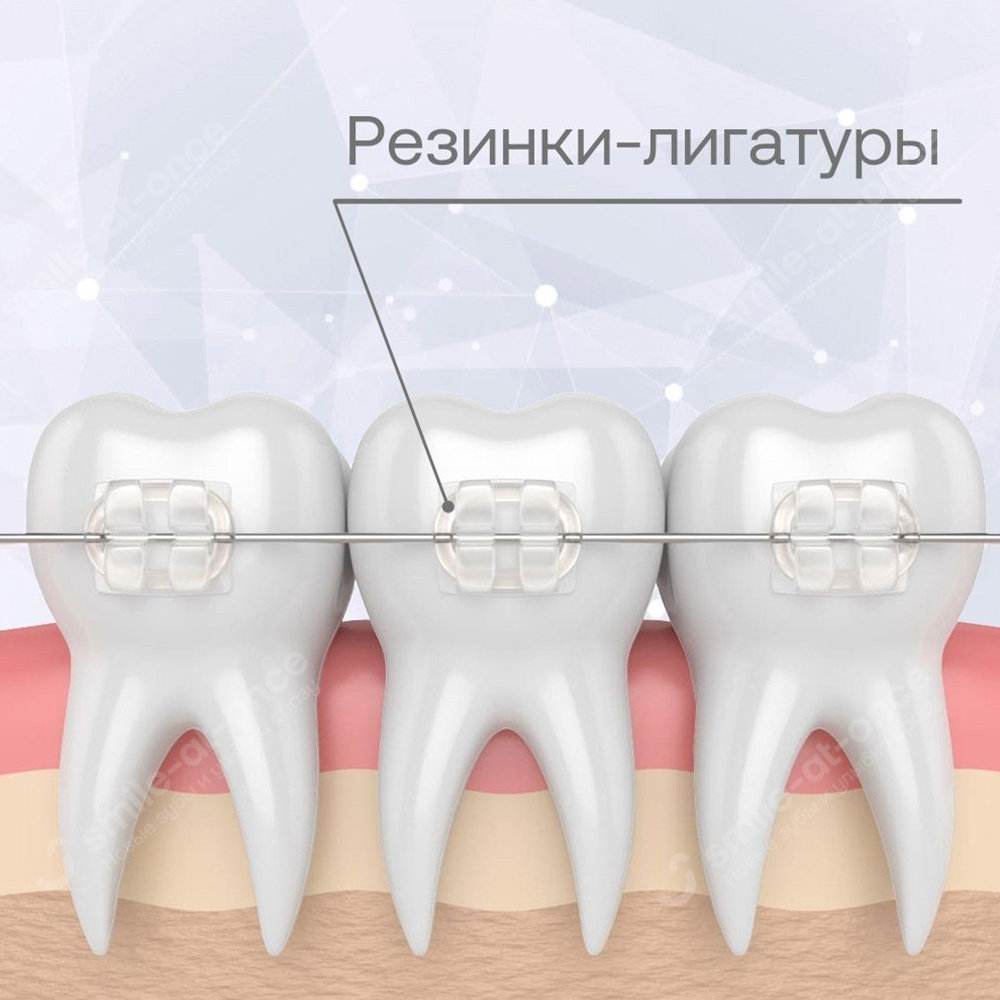 Лигатурные сапфировые брекеты
