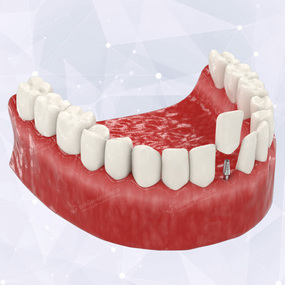 Случаи применения керамокомпозитных зубных протезов