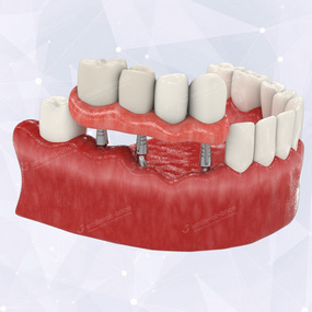Случаи применения керамокомпозитных зубных протезов