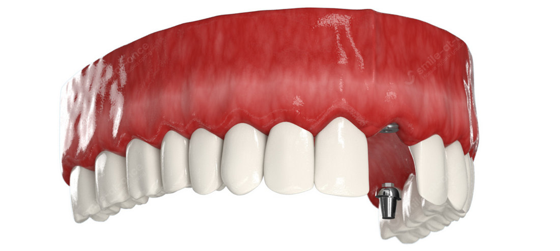 Этапы проведения двухэтапной имплантации зубов