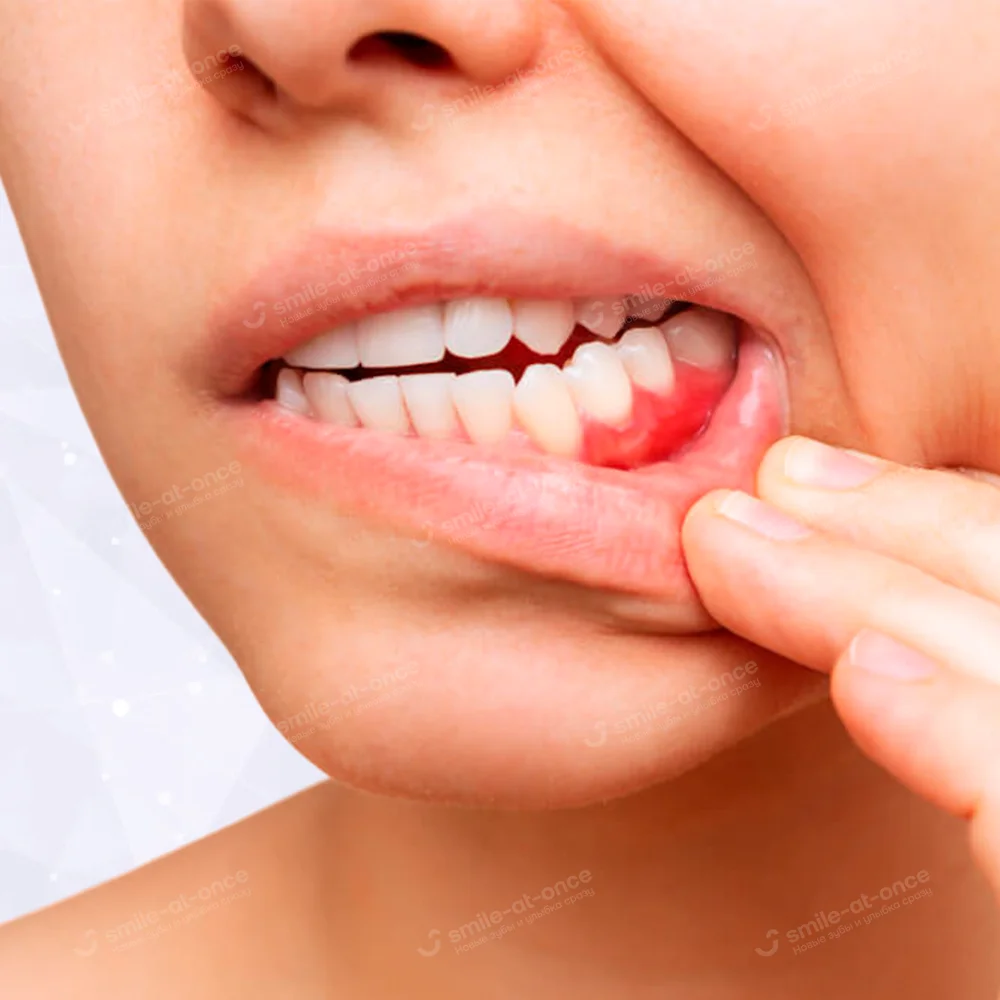 Чем полоскать рот при воспалении десен: действенные средства и растворы для полоскания