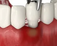 Лечение флюса с удалением зуба