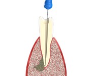 Лечение зубных каналов