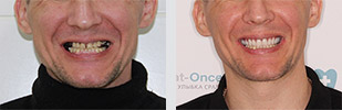 фото до и после имплантации