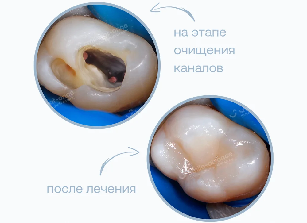 Ювелирное восстановление коронки зуба