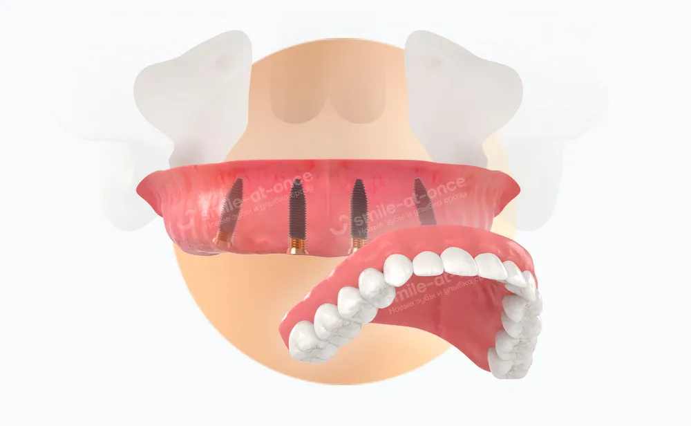 Мобилизация и лечение зубов