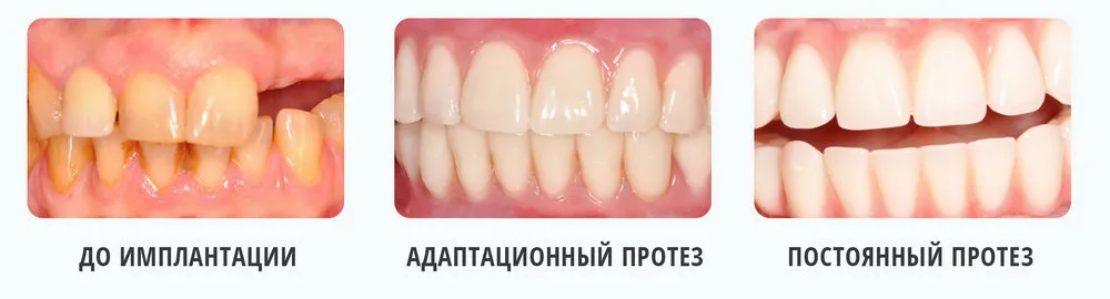 Процесс лечения и изменения зубов