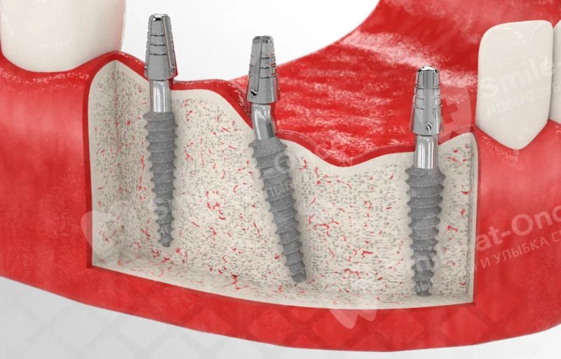 Установленные зубные имплантаты