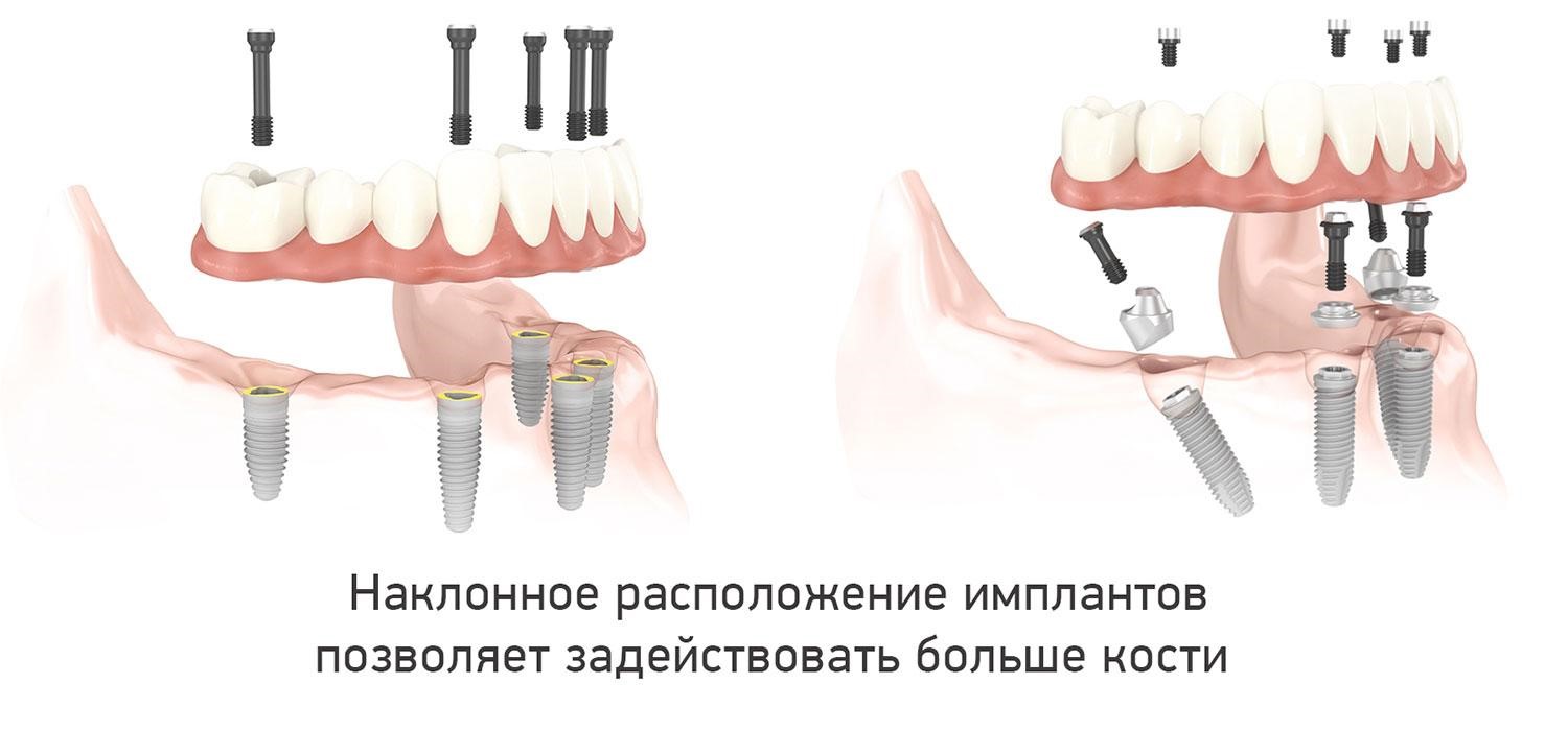 Наклонное расположение зубных имплантов