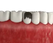 Художественное наращивание треснутого зуба