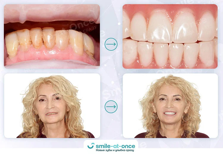 фото до и после имплантации зубов