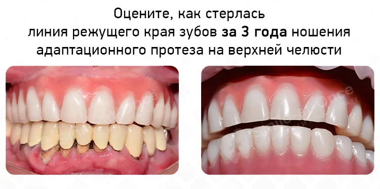 износ зубного протеза