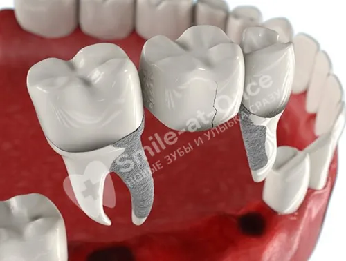 Неефективность зубных протезов при пародонтите