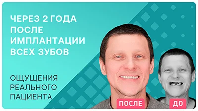 Видео-отзыв о комплексной имплантации зубов