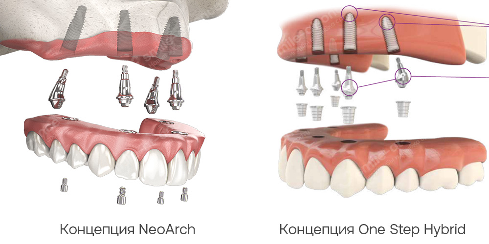Все зубы за 1 день на имплантах Неодент из Бразилии