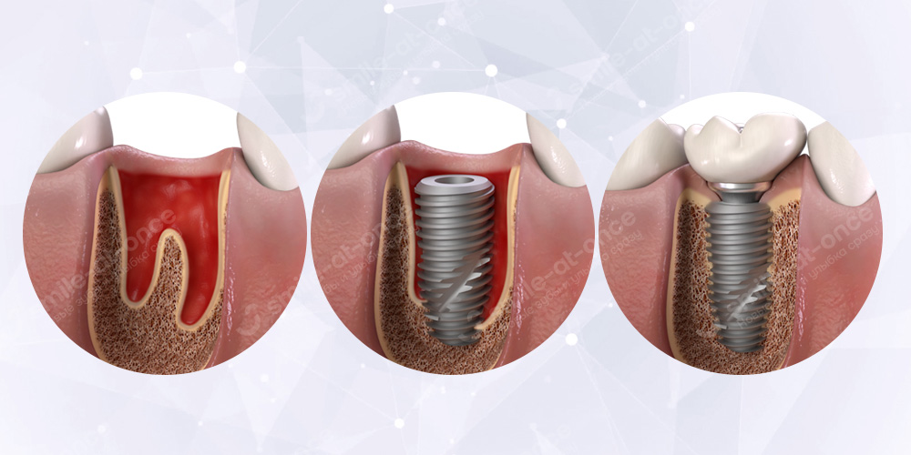 Зубы за 1 день на имплантах Неодент из Бразилии
