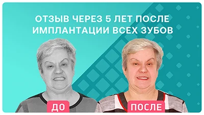 Видео - Комплексная имплантация – отзыв через 5 лет: сколько прослужили адаптационные протезы