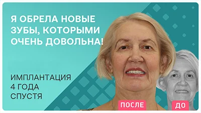 Видео - Комплексная имплантация: отзыв через 4 года после сервисного осмотра