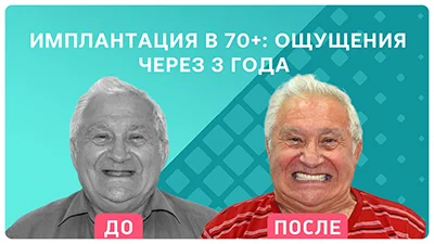 Видео - Комплексная имплантация в 70+: ощущения через 3 года