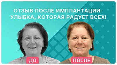 Видео - Улыбка, которая радует всех! Ощущения после комплексной имплантации зубов