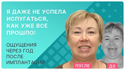 Видео - Отзыв через год после комплексной имплантации верхней челюсти