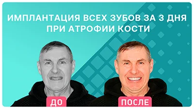 Видео - ДО и ПОСЛЕ комплексной имплантации. Новые зубы за 3 дня с пожизненной гарантией