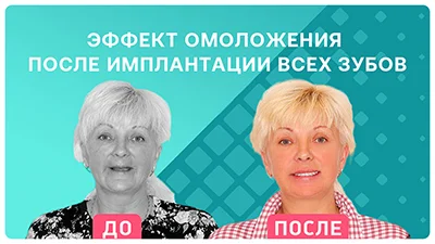 Видео - Комплексная имплантация зубов за 4 дня с моментальной установкой протеза