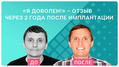 Видео - «Скажу честно: я доволен!» – отзыв пациента об имплантации с немедленной нагрузкой