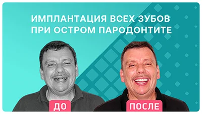 Видео - Кардинальное преображение за 3 дня. Отзыв пациента о комплексной имплантации зубов