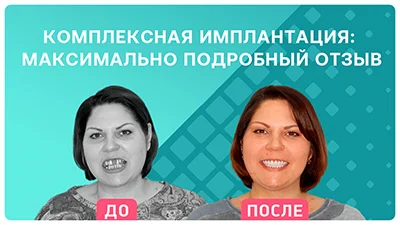 Комплексная имплантация 6 месяцев назад у Ирины