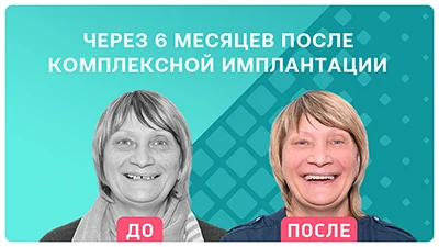 Видео - Видео-отзыв пациентки через 6 месяцев после комплексной имплантации верхней челюсти