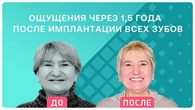 Видео - Новые зубы – как родные! Отзыв пациента об имплантации за 3 дня