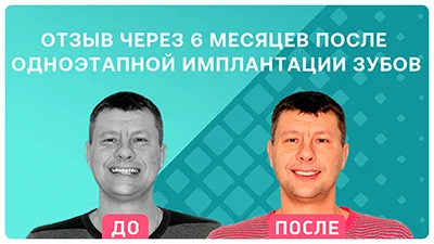 Видео - Отзыв пациента спустя полгода после проведения одноэтапной имплантации