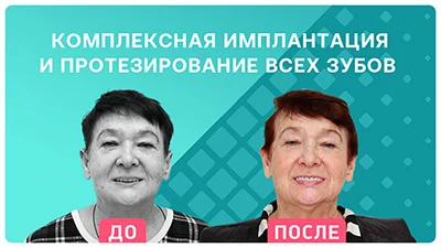 Видео - Комплексная имплантация: протезирование всех зубов