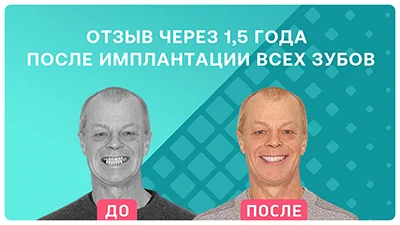 Видео - Через 1,5 года после имплантации: о лечении и бесплатном сервисном обслуживании