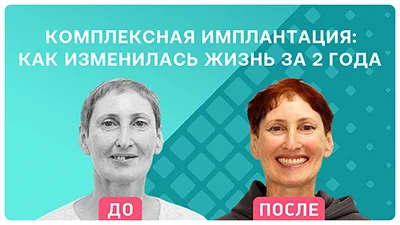 Видео - Как изменилась жизнь после комплексной имплантации: репортаж через 2 года