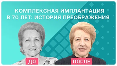 Видео - Комплексная имплантация в 70 лет: история преображения пациентки