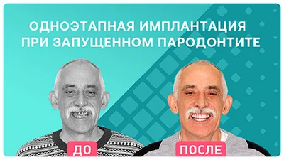 Видео - Одноэтапная имплантация на фоне запущенного пародонтита: отзыв пациента