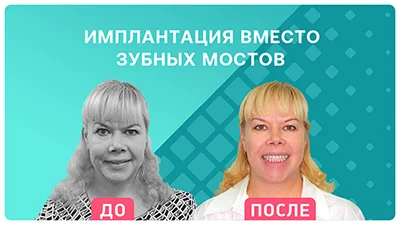 Видео - Моментальное восстановление всех зубов. Отзыв пациентки о комплексной имплантации