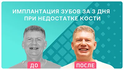 Видео - Комплексное восстановление зубов: отзыв пациента из Оренбурга о комплексной имплантации