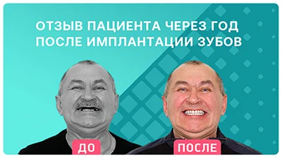 Видео - Отзыв пациента через год после проведения имплантации зубов