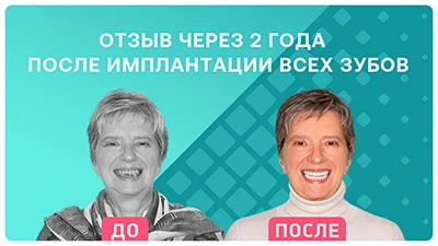 Видео - Отзыв через 2 года после комплексной имплантации и смены адаптационного протеза