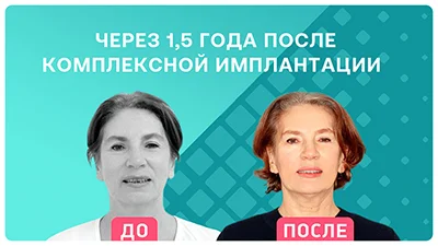 Видео - Через 1,5 года после комплексной имплантации и установки протеза из керамокомпозита