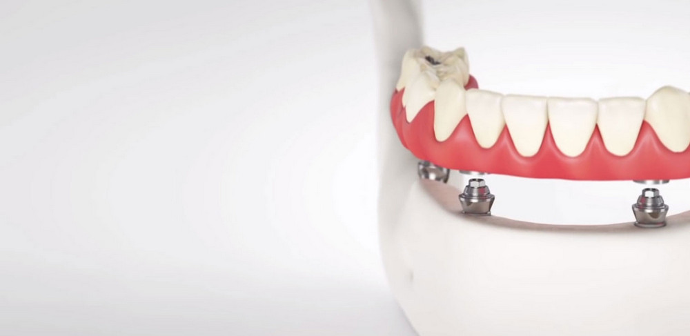 Отличие TeethXpress от других моделей имплантов