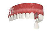 Имплантация 1-2 зубов