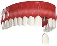 Одноэтапная имплантация переднего зуба