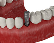 Одноэтапная имплантация при потере зубов