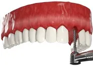 Одномоментная имплантация переднего зуба